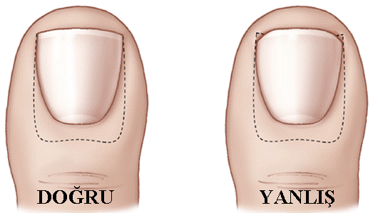 tırnak-batması-nasıl-geçer
